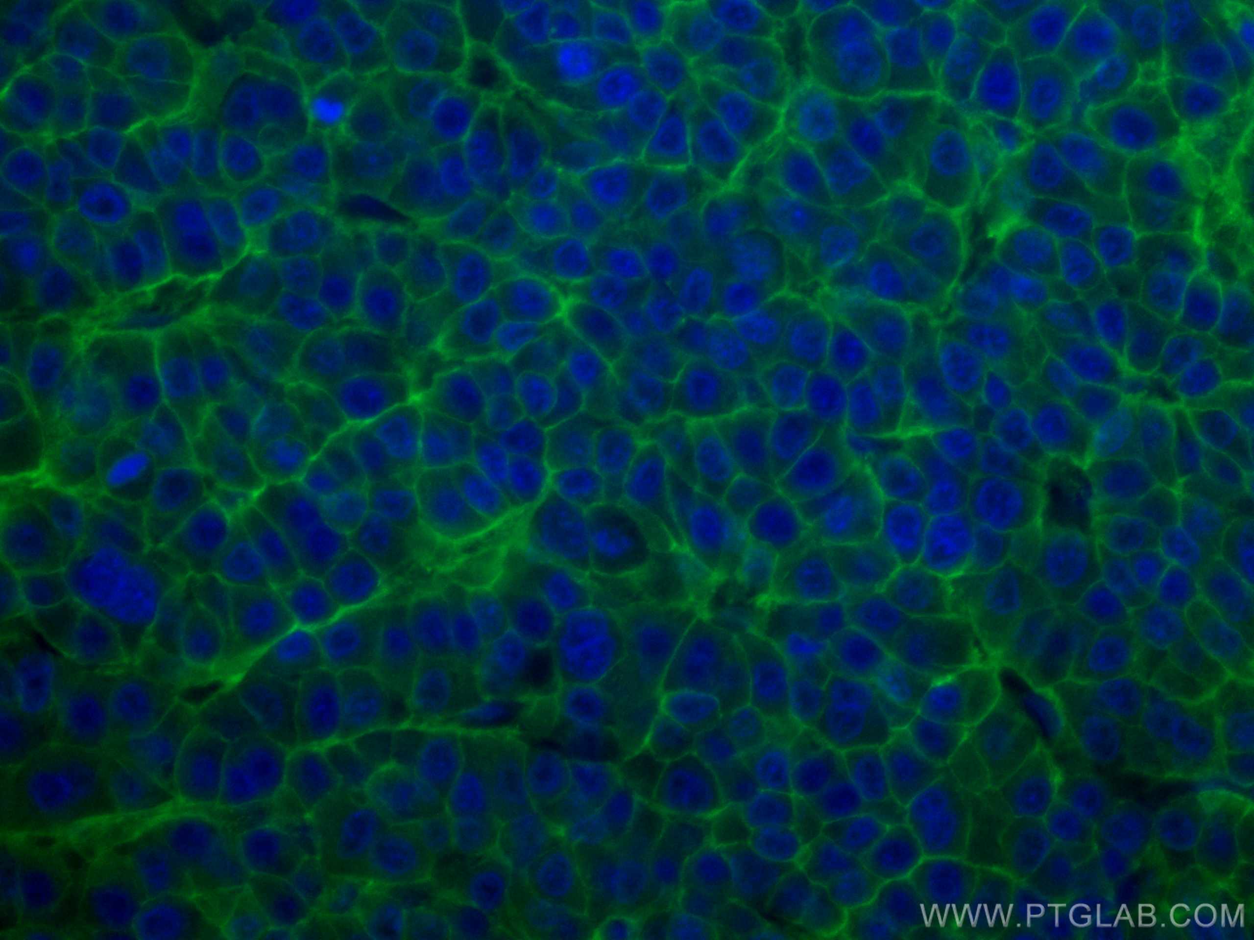 Immunofluorescence (IF) / fluorescent staining of human liver cancer tissue using CoraLite® Plus 488-conjugated SLC31A1 Monoclonal a (CL488-67221)