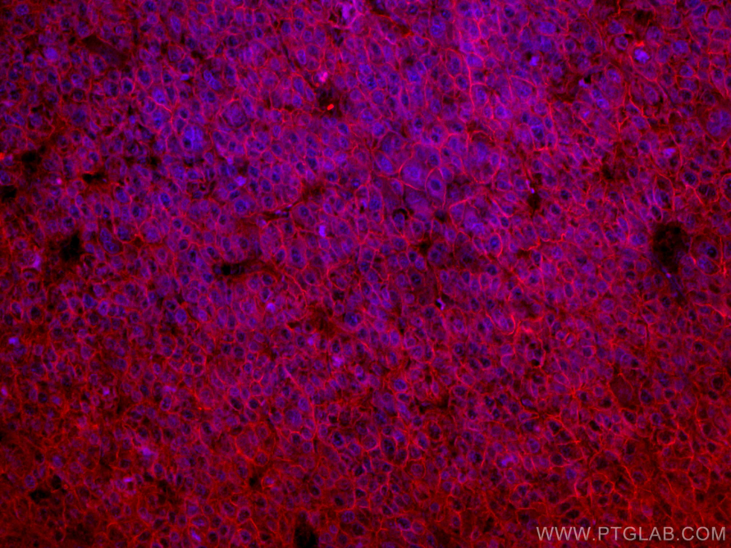 Immunofluorescence (IF) / fluorescent staining of human liver cancer tissue using CoraLite®594-conjugated SLC31A1 Monoclonal antibod (CL594-67221)