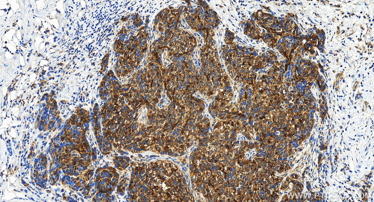 Immunohistochemistry (IHC) staining of human ovary cancer tissue using SLC34A2 Polyclonal antibody (21295-1-AP)