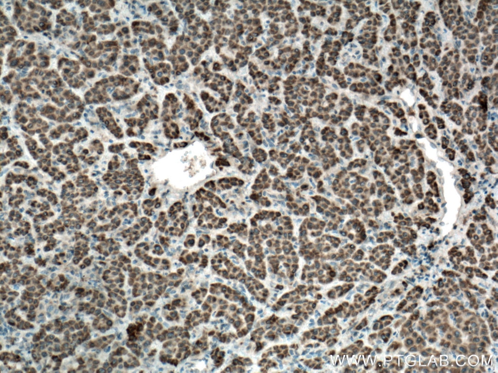 Immunohistochemistry (IHC) staining of human liver cancer tissue using SLC35A2 Polyclonal antibody (13657-1-AP)