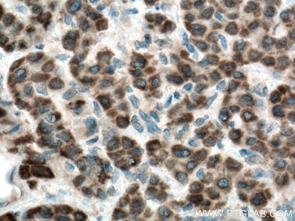 Immunohistochemistry (IHC) staining of human liver cancer tissue using SLC35A2 Polyclonal antibody (13657-1-AP)