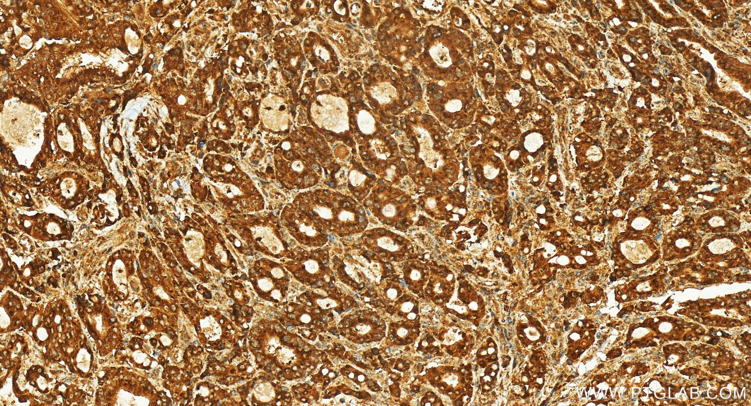 Immunohistochemistry (IHC) staining of human stomach cancer tissue using SLC37A1 Polyclonal antibody (24582-1-AP)
