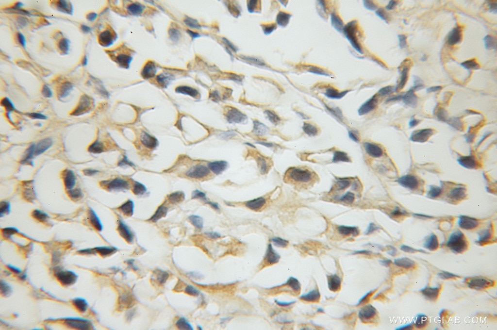 Immunohistochemistry (IHC) staining of human prostate cancer tissue using SLC38A1 Polyclonal antibody (12039-1-AP)