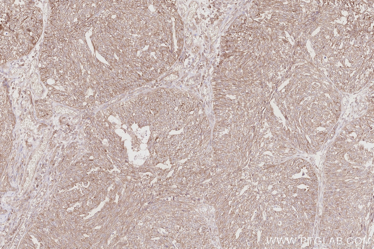 Immunohistochemistry (IHC) staining of human ovary cancer tissue using SLC38A1 Polyclonal antibody (28632-1-AP)