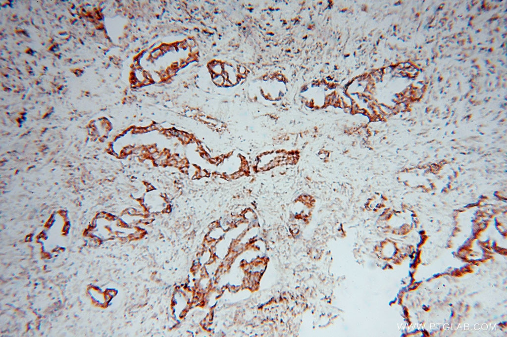 Immunohistochemistry (IHC) staining of human lung cancer tissue using SLC38A3 Polyclonal antibody (14315-1-AP)
