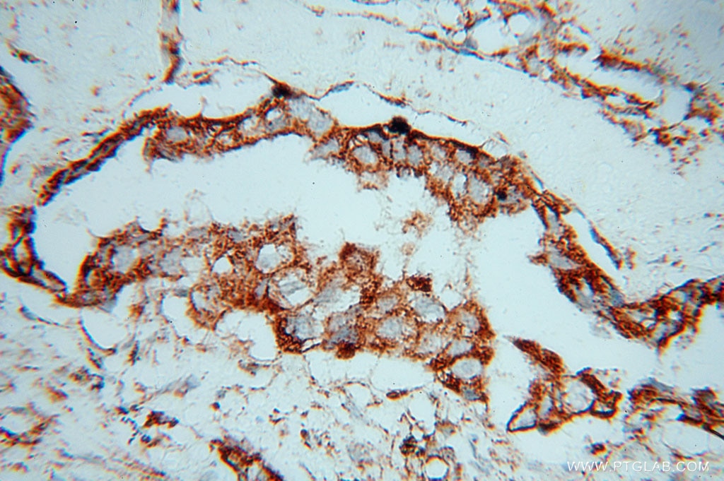 Immunohistochemistry (IHC) staining of human lung cancer tissue using SLC38A3 Polyclonal antibody (14315-1-AP)