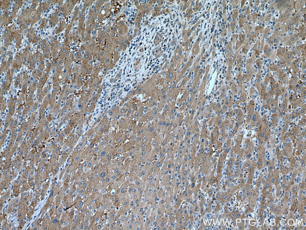 Immunohistochemistry (IHC) staining of human liver cancer tissue using SLC38A4 Polyclonal antibody (20857-1-AP)