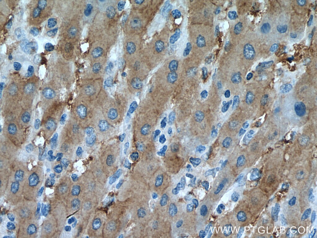 Immunohistochemistry (IHC) staining of human liver cancer tissue using SLC38A4 Polyclonal antibody (20857-1-AP)