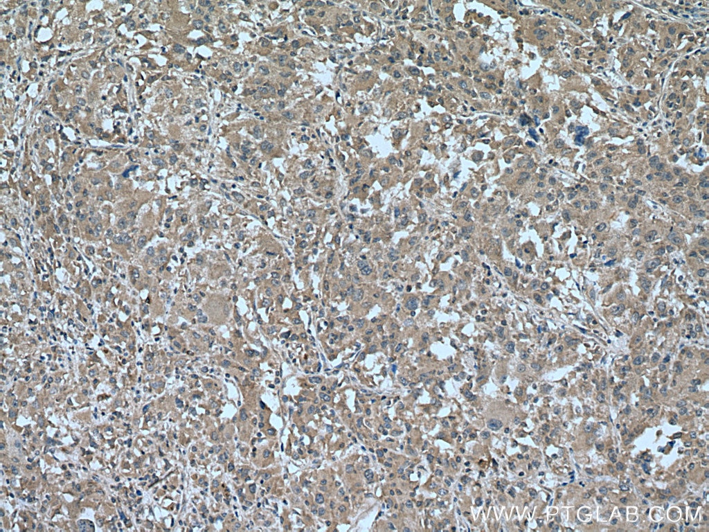 IHC staining of human liver cancer using 20857-1-AP