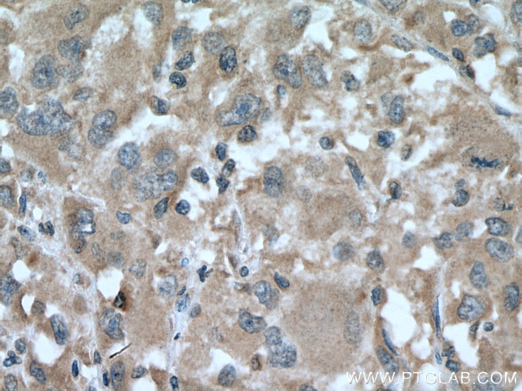 Immunohistochemistry (IHC) staining of human liver cancer tissue using SLC38A4 Polyclonal antibody (20857-1-AP)