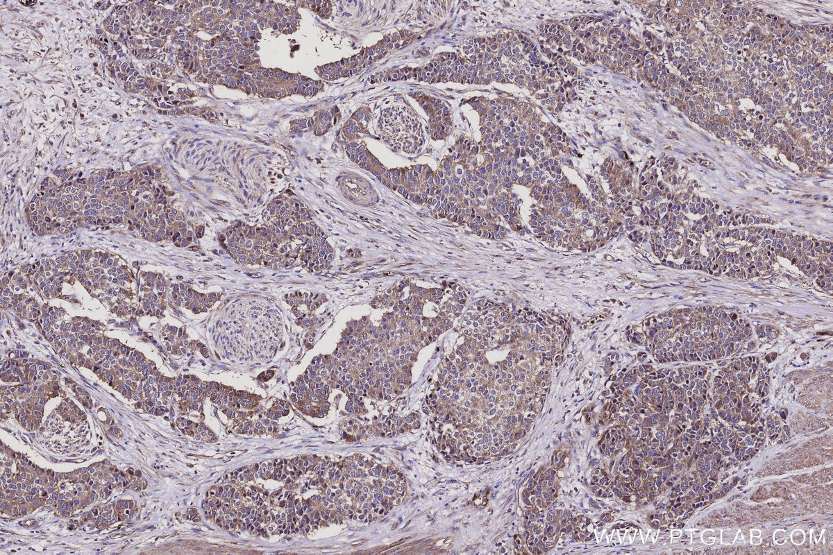 IHC staining of human stomach cancer using 20458-1-AP Immunohistochemistry (IHC) staining of human stomach cancer tissue using SLC39A3 Polyclonal antibody (20458-1-AP)