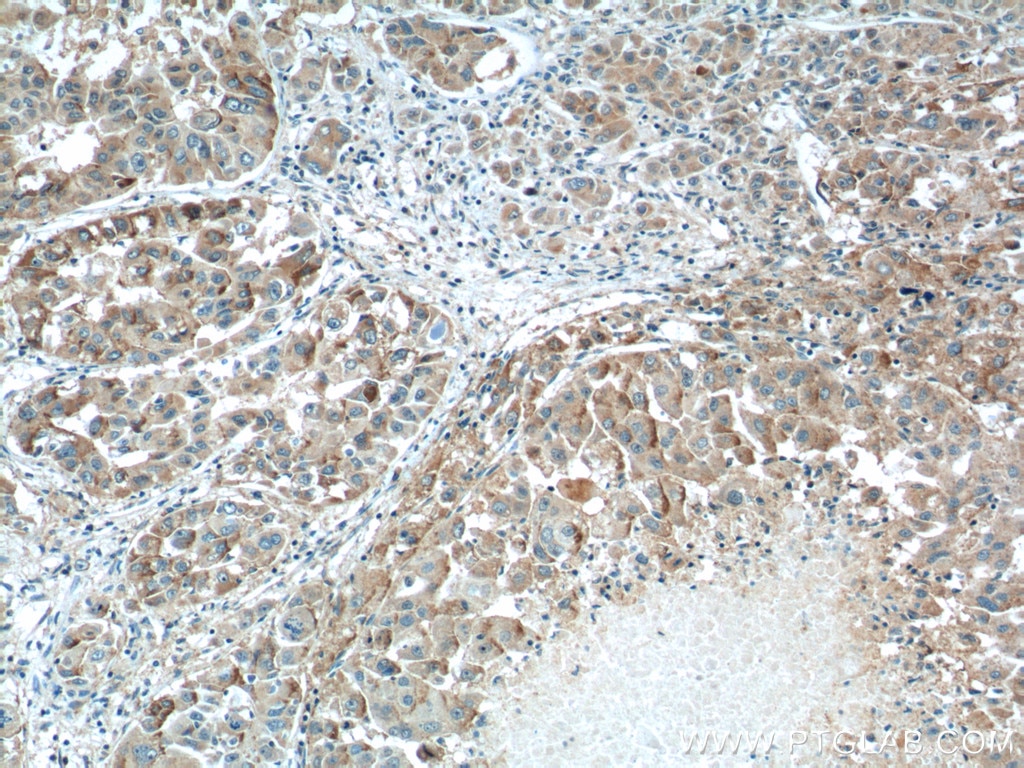 Immunohistochemistry (IHC) staining of human liver cancer tissue using ZIP4 Polyclonal antibody (20625-1-AP)