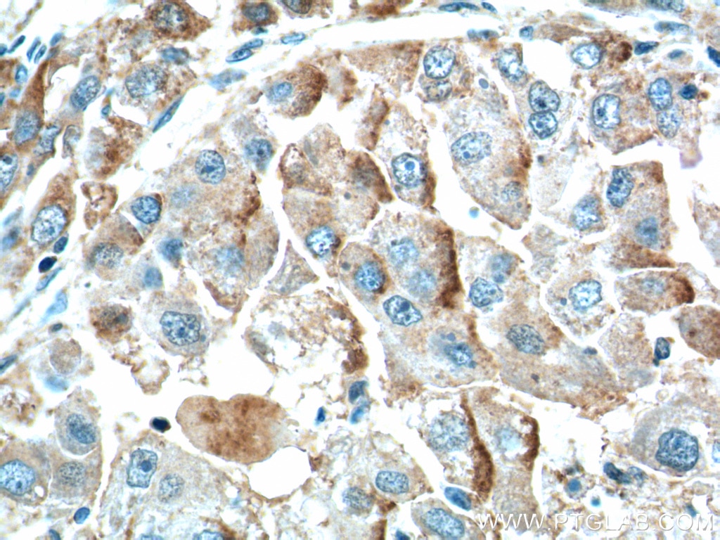 IHC staining of human liver cancer using 20625-1-AP