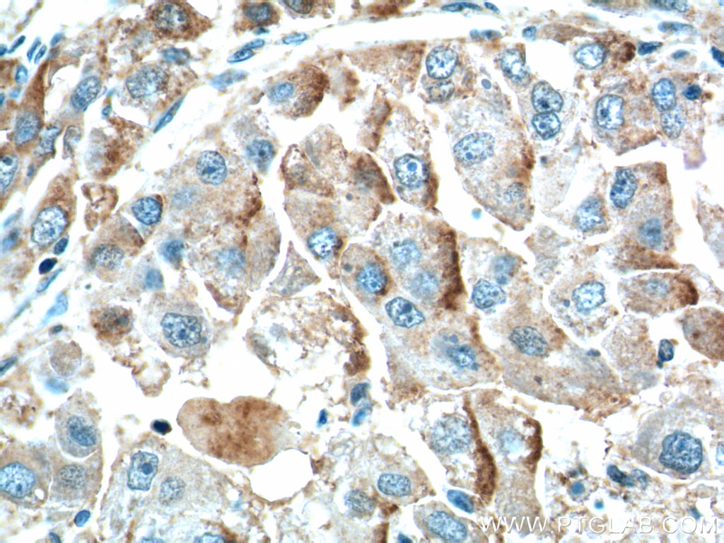 Immunohistochemistry (IHC) staining of human liver cancer tissue using ZIP4 Polyclonal antibody (20625-1-AP)