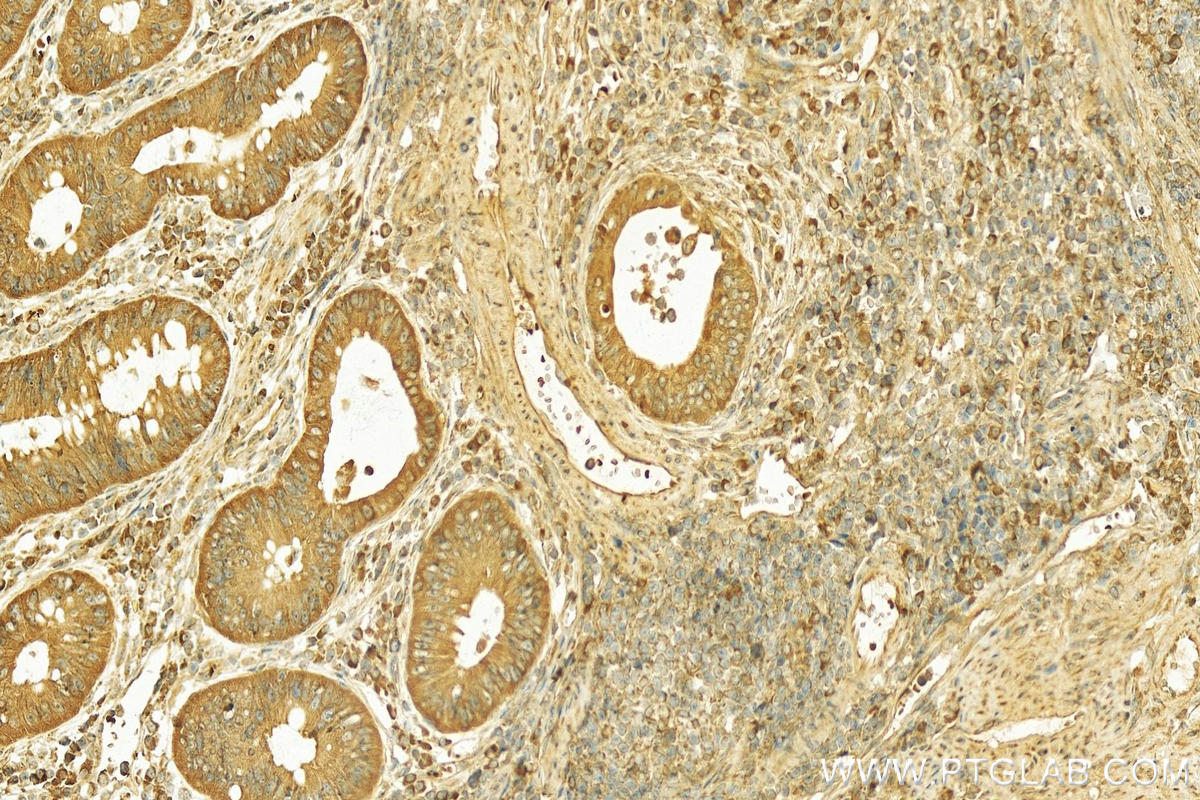Immunohistochemistry (IHC) staining of human colon cancer tissue using SLC39A5 Polyclonal antibody (17285-1-AP)