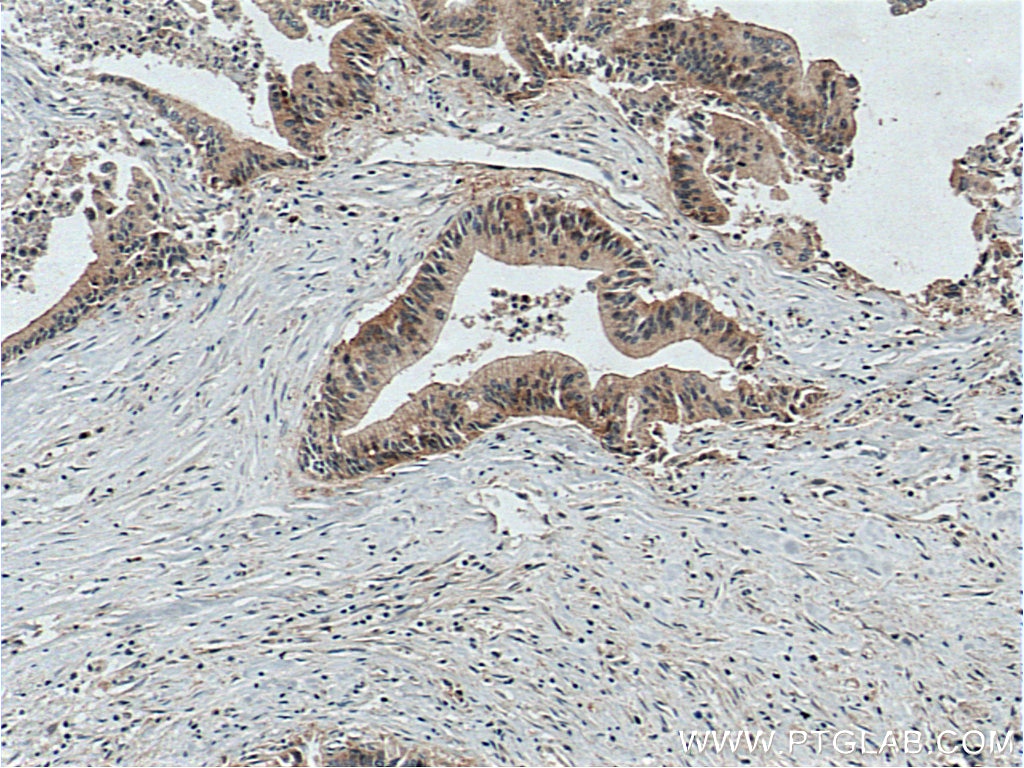 IHC staining of human pancreas cancer using 14236-1-AP