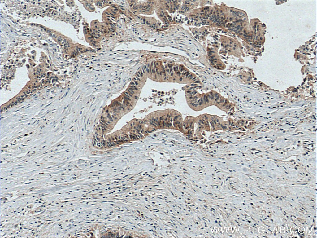 Immunohistochemistry (IHC) staining of human pancreas cancer tissue using LIV-1/ZIP6 Polyclonal antibody (14236-1-AP)