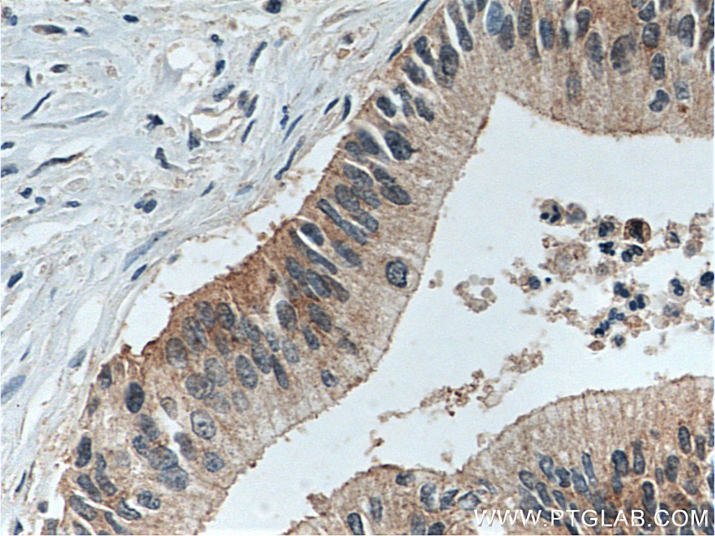 Immunohistochemistry (IHC) staining of human pancreas cancer tissue using LIV-1/ZIP6 Polyclonal antibody (14236-1-AP)
