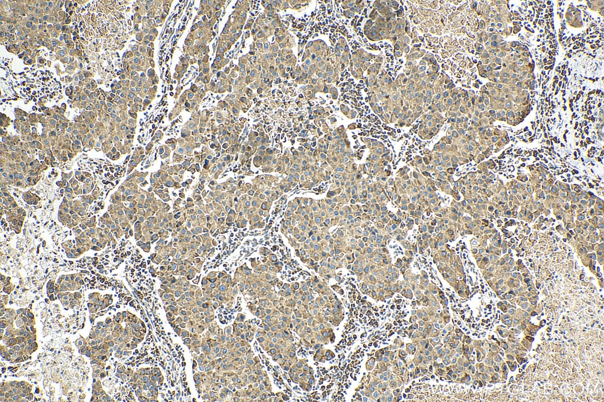 IHC staining of human breast cancer using 19429-1-AP