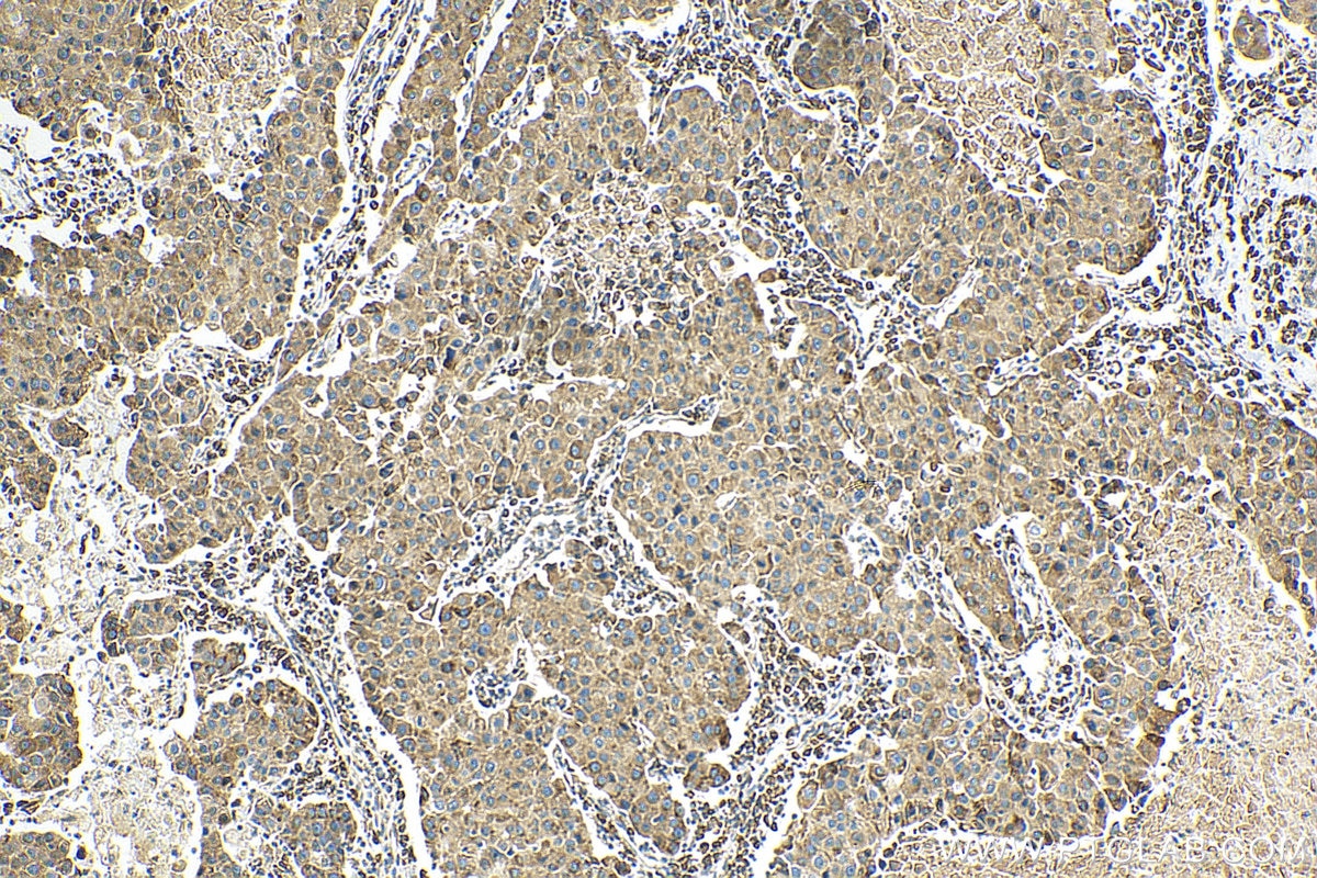 Immunohistochemistry (IHC) staining of human breast cancer tissue using ZIP7 Polyclonal antibody (19429-1-AP)