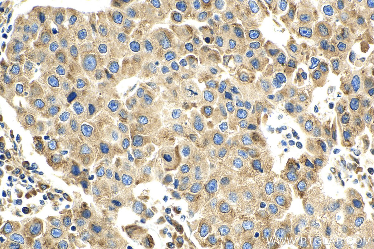 Immunohistochemistry (IHC) staining of human breast cancer tissue using ZIP7 Polyclonal antibody (19429-1-AP)