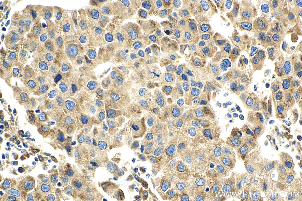 Immunohistochemistry (IHC) staining of human breast cancer tissue using ZIP7 Polyclonal antibody (19429-1-AP)