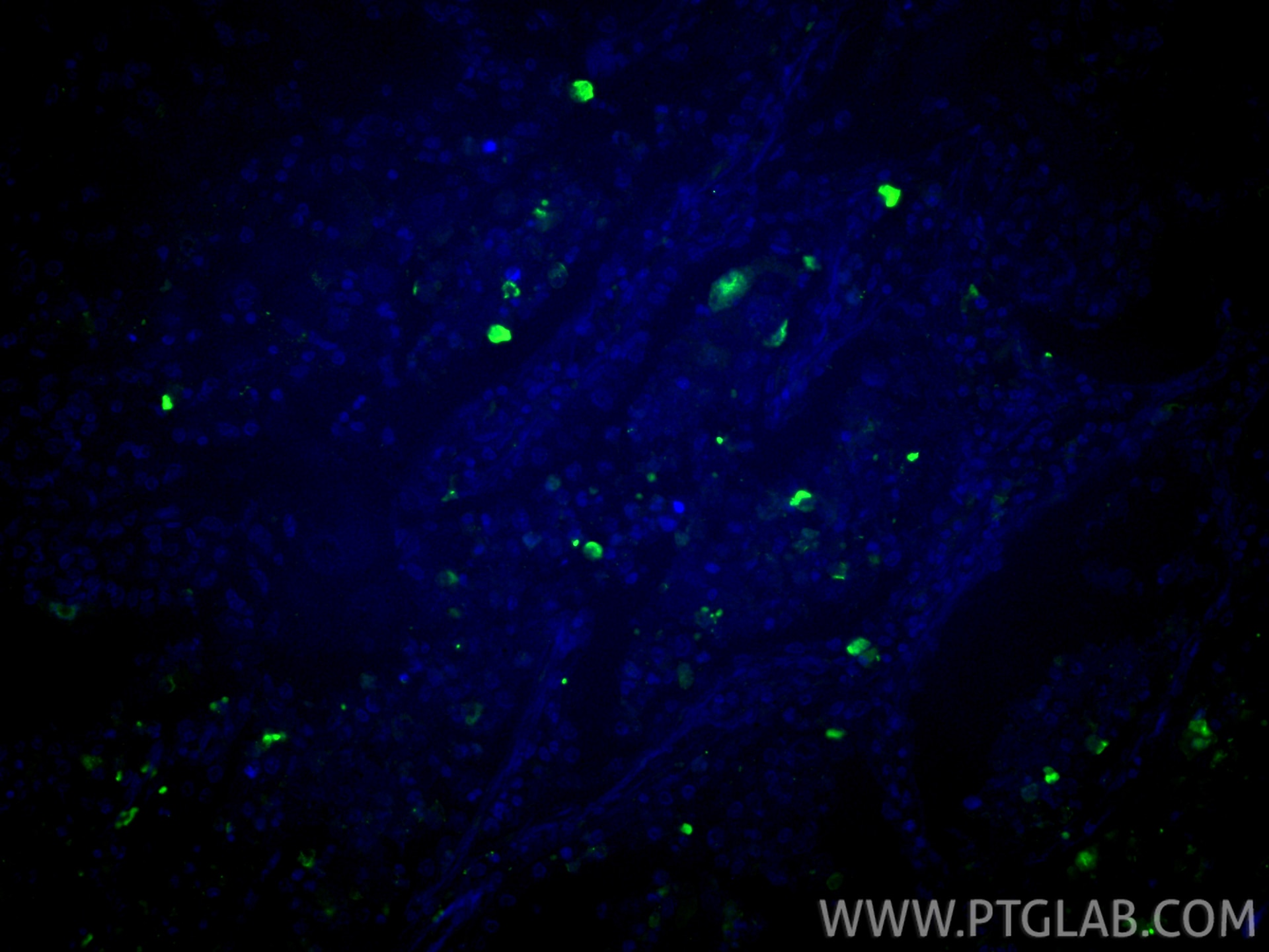 Immunofluorescence (IF) / fluorescent staining of human lung cancer tissue using SLC43A2 Polyclonal antibody (30031-1-AP)