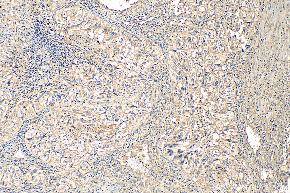 Immunohistochemistry (IHC) staining of human lung cancer tissue using SLC44A1 Polyclonal antibody (14687-1-AP)