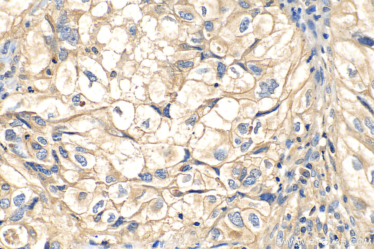 Immunohistochemistry (IHC) staining of human lung cancer tissue using SLC44A1 Polyclonal antibody (14687-1-AP)