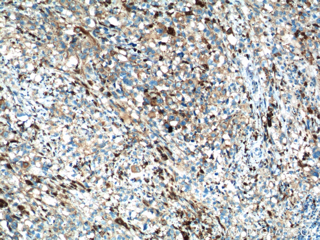 Immunohistochemistry (IHC) staining of human malignant melanoma tissue using SLC45A2 Polyclonal antibody (10453-1-AP)