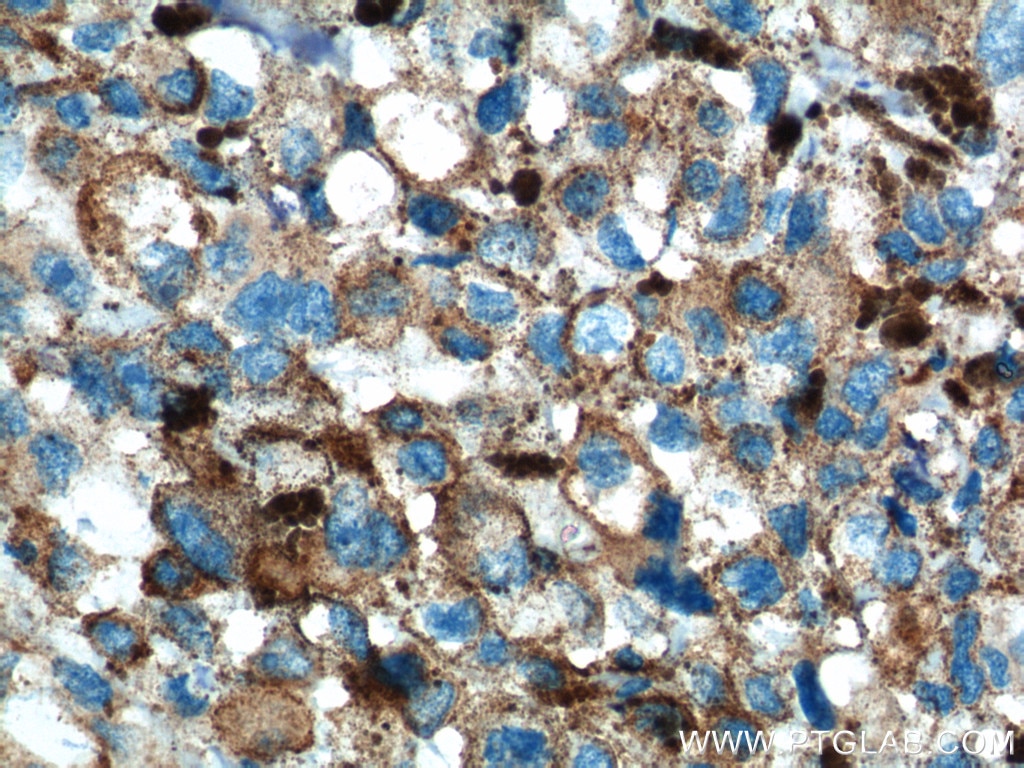 Immunohistochemistry (IHC) staining of human malignant melanoma tissue using SLC45A2 Polyclonal antibody (10453-1-AP)