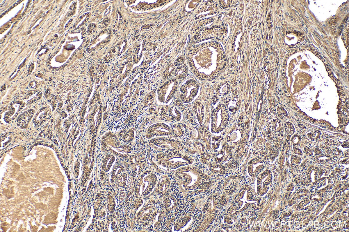 IHC staining of human prostate hyperplasia using 14224-1-AP