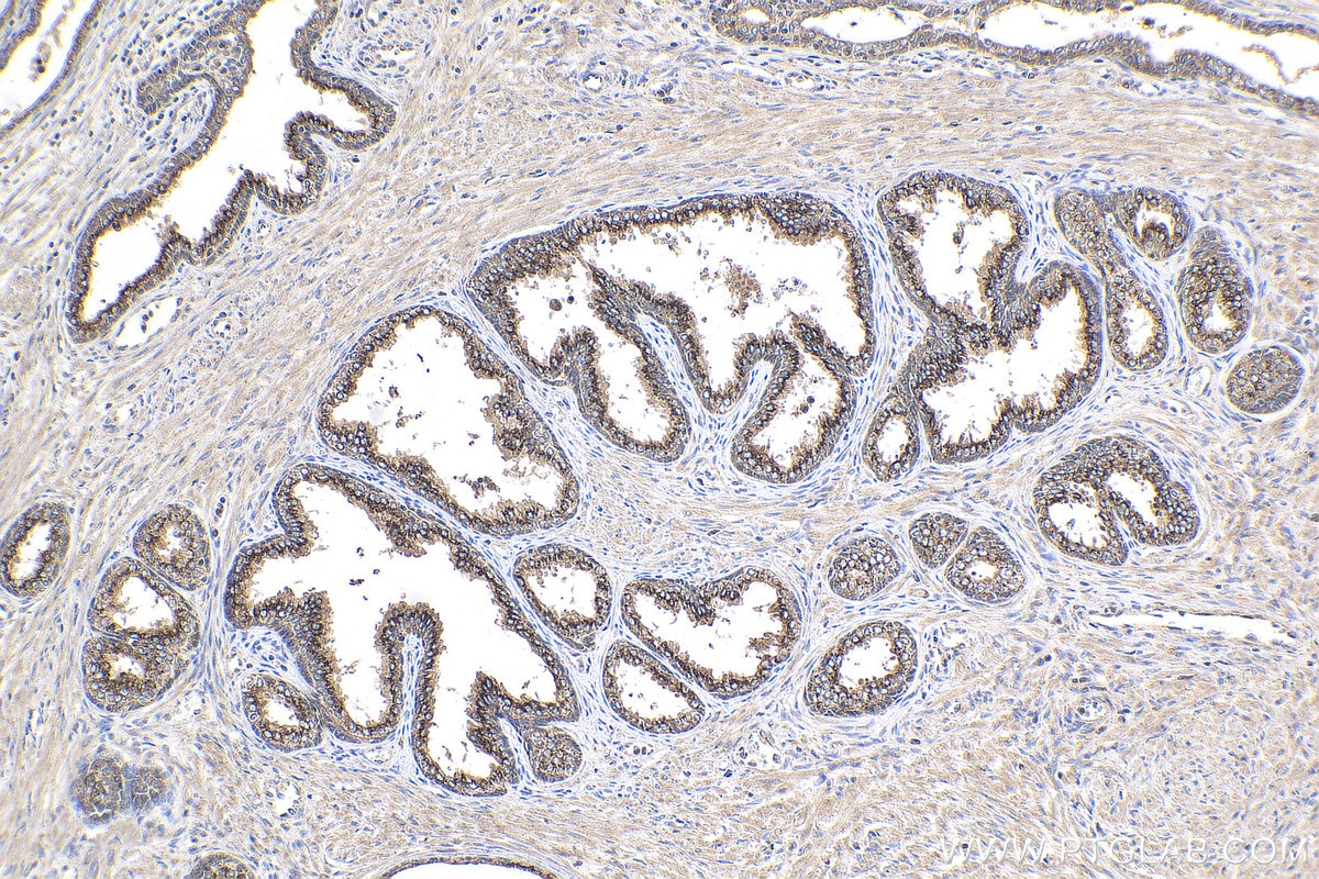 Immunohistochemistry (IHC) staining of human prostate cancer tissue using Prostein Polyclonal antibody (14224-1-AP)