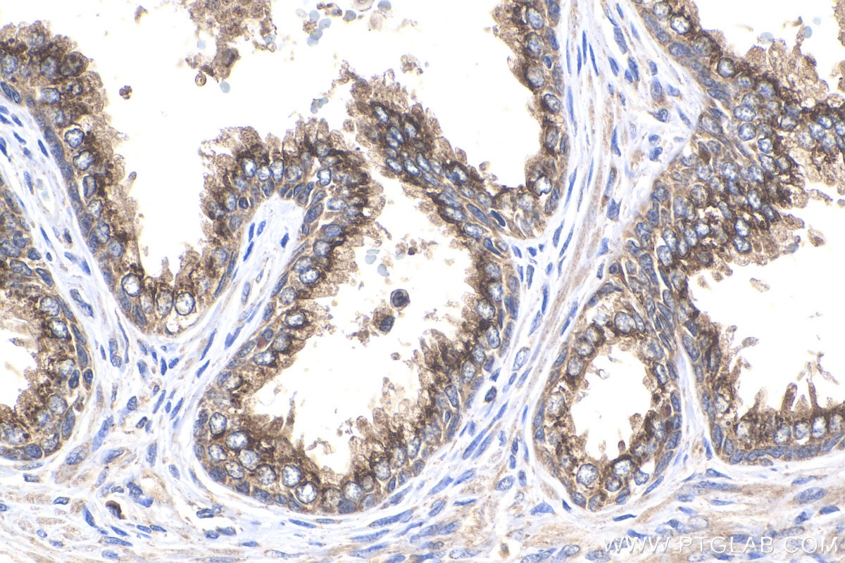 Immunohistochemistry (IHC) staining of human prostate cancer tissue using Prostein Polyclonal antibody (14224-1-AP)