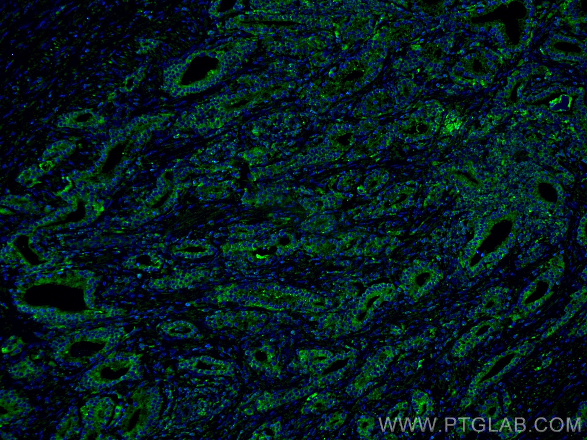 Immunofluorescence (IF) / fluorescent staining of human prostate cancer tissue using Prostein Monoclonal antibody (60343-1-Ig)