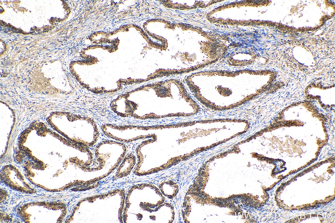 Immunohistochemistry (IHC) staining of human prostate cancer tissue using Prostein Monoclonal antibody (60343-1-Ig)