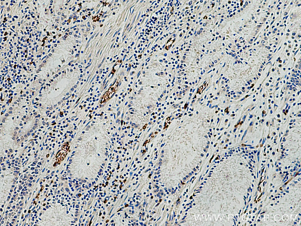 Immunohistochemistry (IHC) staining of human stomach cancer tissue using Band 3/ AE1 Polyclonal antibody (18566-1-AP)