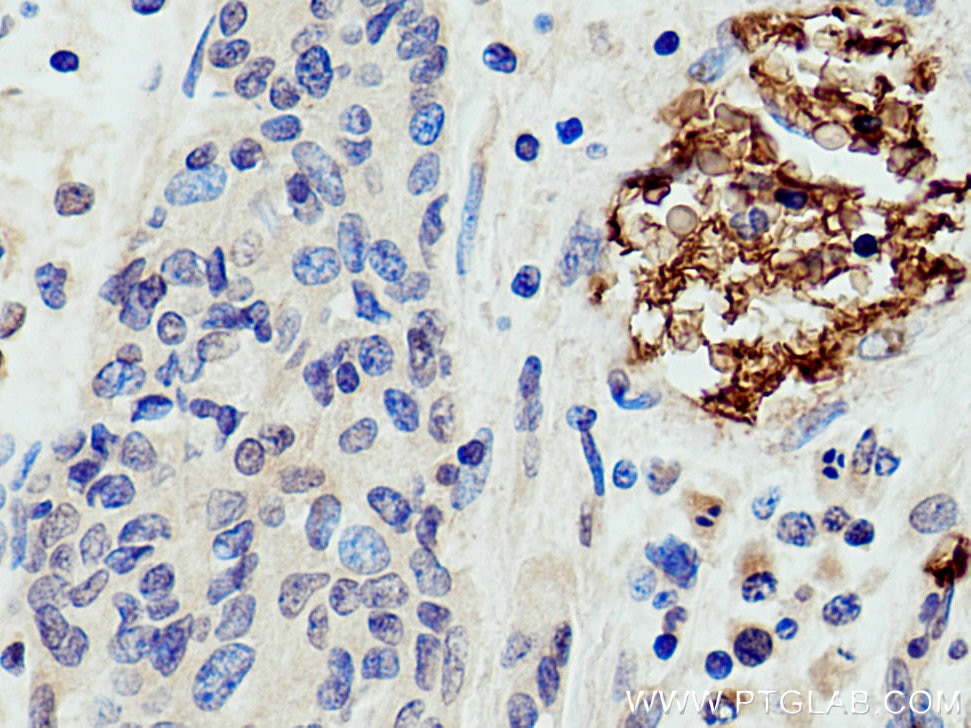Immunohistochemistry (IHC) staining of human stomach cancer tissue using Band 3/ AE1 Polyclonal antibody (18566-1-AP)