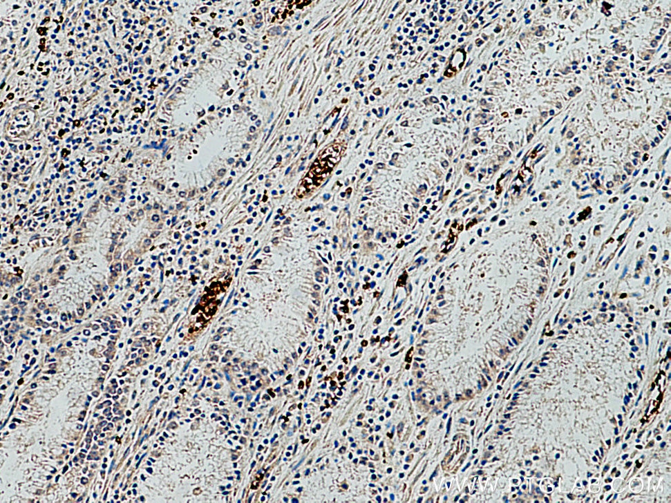 Immunohistochemistry (IHC) staining of human stomach cancer tissue using Band 3/ AE1 Polyclonal antibody (28131-1-AP)