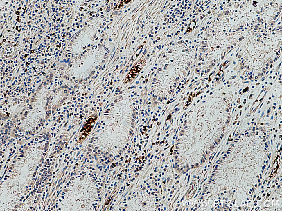 IHC staining of human stomach cancer using 28131-1-AP