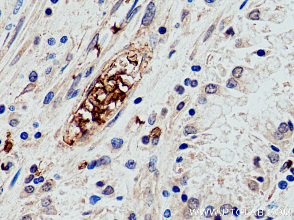 IHC staining of human stomach cancer using 28131-1-AP