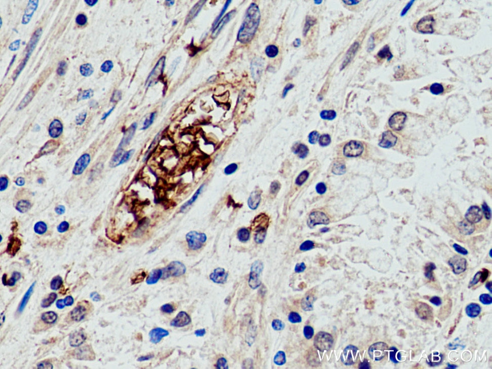 Immunohistochemistry (IHC) staining of human stomach cancer tissue using Band 3/ AE1 Polyclonal antibody (28131-1-AP)