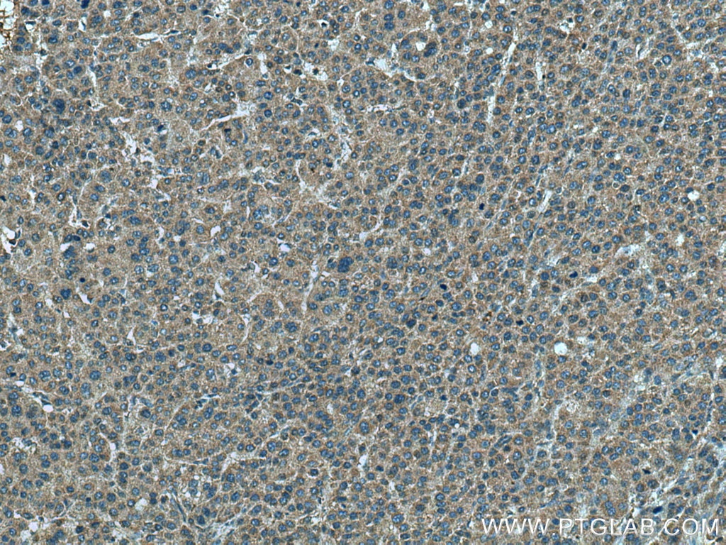 Immunohistochemistry (IHC) staining of human liver cancer tissue using SLC5A10 Polyclonal antibody (17341-1-AP)