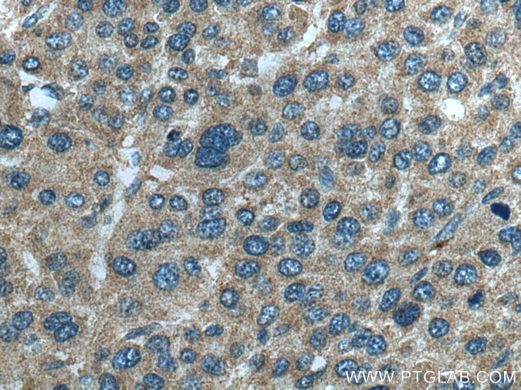 Immunohistochemistry (IHC) staining of human liver cancer tissue using SLC5A10 Polyclonal antibody (17341-1-AP)