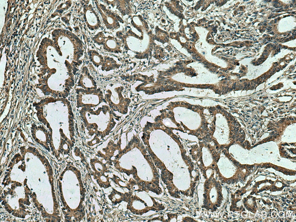 Immunohistochemistry (IHC) staining of human colon cancer tissue using SLC5A11 Polyclonal antibody (14089-1-AP)