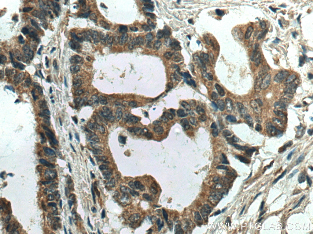 Immunohistochemistry (IHC) staining of human colon cancer tissue using SLC5A11 Polyclonal antibody (14089-1-AP)