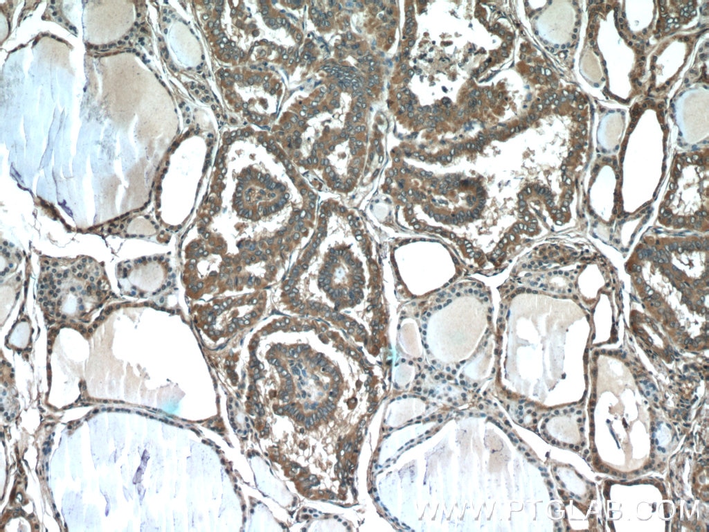 Immunohistochemistry (IHC) staining of human thyroid cancer tissue using Sodium iodide symporter Polyclonal antibody (24324-1-AP)