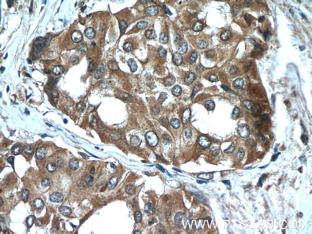 Immunohistochemistry (IHC) staining of human thyroid cancer tissue using Sodium iodide symporter Polyclonal antibody (24324-1-AP)