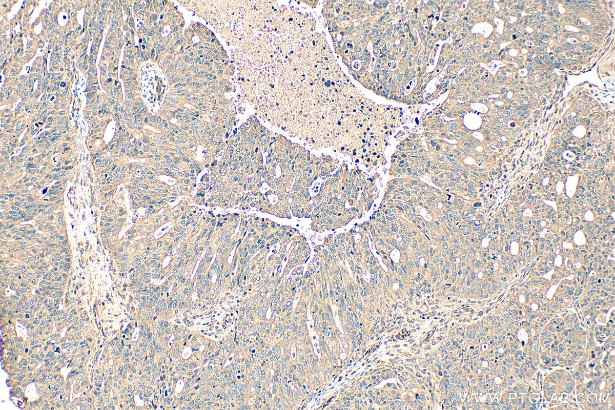 Immunohistochemistry (IHC) staining of human ovary tumor tissue using SLC7A1/CAT-1 Polyclonal antibody (14195-1-AP)