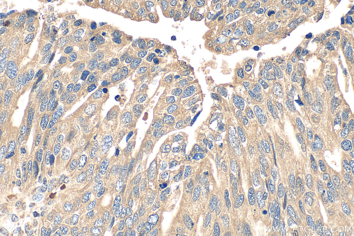 Immunohistochemistry (IHC) staining of human ovary tumor tissue using SLC7A1/CAT-1 Polyclonal antibody (14195-1-AP)